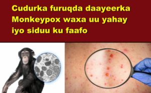 Cudurka furuqda daayeerka Monkeypox waxa uu yahay iyo siduu ku faafo