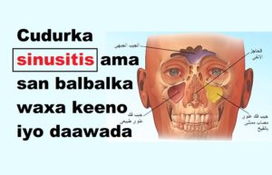 Cudurka sinusitis ama san balbalka waxa keeno iyo daawada