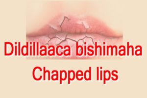 Dildillaaca bishimaha Chapped lips