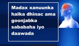 Madax xanuunka halka dhinac ama goonjabka sababaha iyo daawada