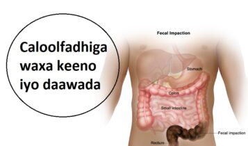 Caloolfadhiga waxa keeno iyo daawada Caloolfadhiga waxa keeno iyo daawada