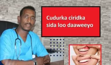 Cudurka ciridka sida loo daaweeyo