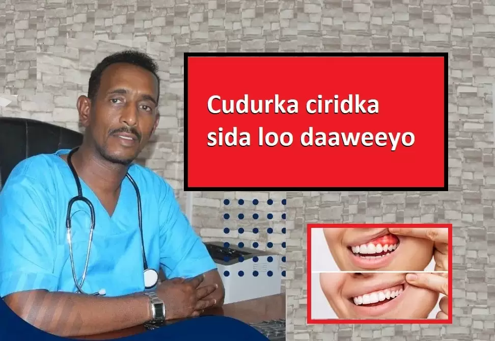 Cudurka ciridka sida loo daaweeyo