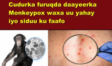 Cudurka furuqda daayeerka Monkeypox waxa uu yahay iyo siduu ku faafo