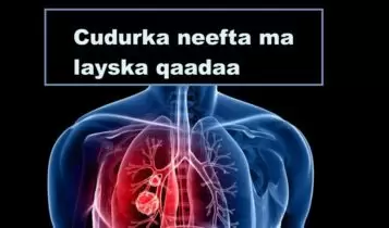 Cudurka neefta ma layska qaadaa Cudurka neefta ma layska qaadaa