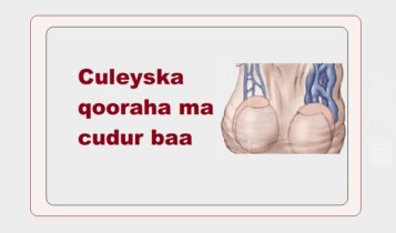 Culeyska qooraha ma cudur baa