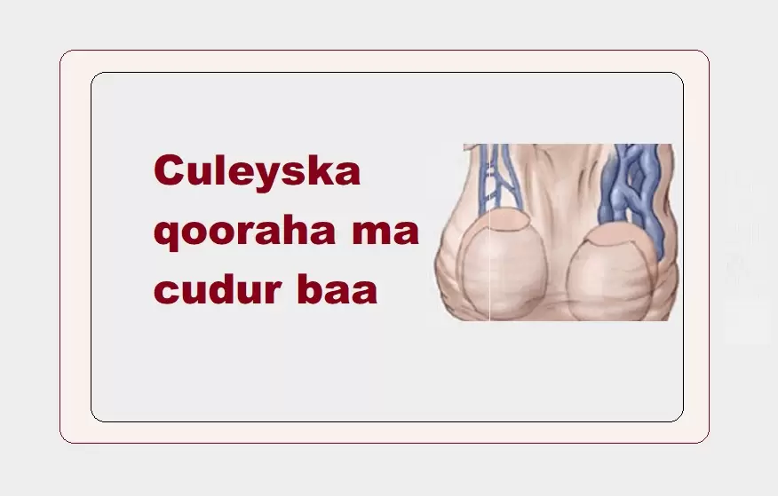 Culeyska qooraha ma cudur baa