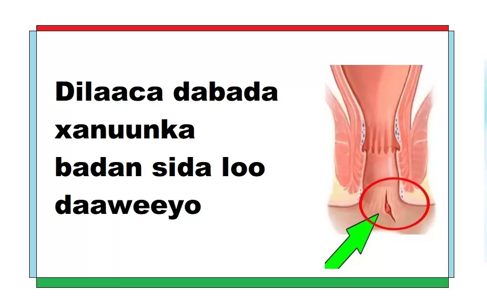 Dilaaca dabada xanuunka badan sida loo daaweeyo