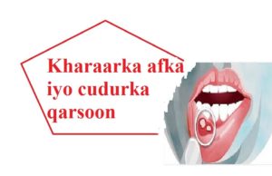 Kharaarka afka iyo cudurka qarsoon