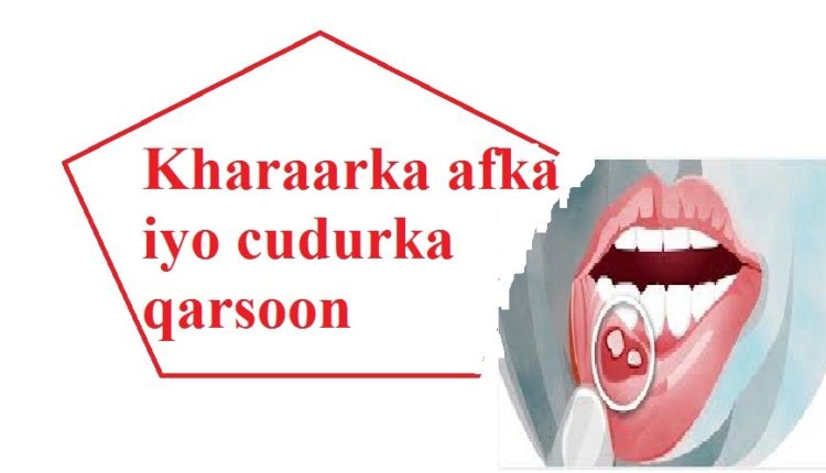 Kharaarka afka iyo cudurka qarsoon