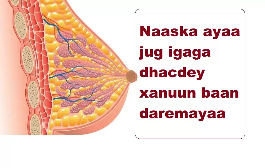 Naaska ayaa jug igaga dhacdey xanuun baan daremayaa