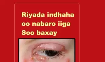 Riyada indhaha oo nabaro iiga Soo baxay Riyada indhaha oo nabaro iiga Soo baxay