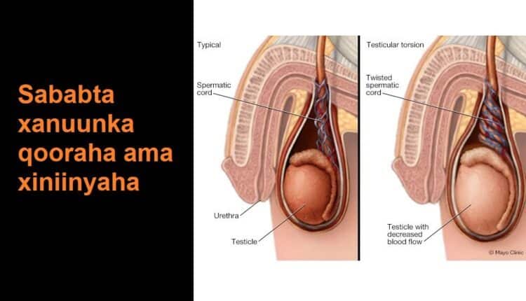 Sababta xanuunka qooraha ama xiniinyaha