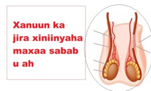 Xanuun ka jira xiniinyaha maxaa sabab u ah