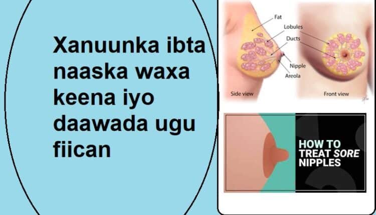 Xanuunka ibta naaska waxa keena iyo daawada ugu fiican