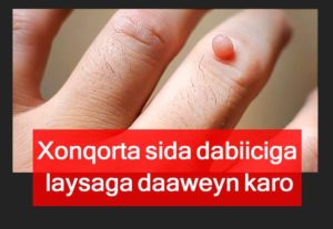 Xonqorta (warts) sida dabiiciga laysaga daaweyn karo