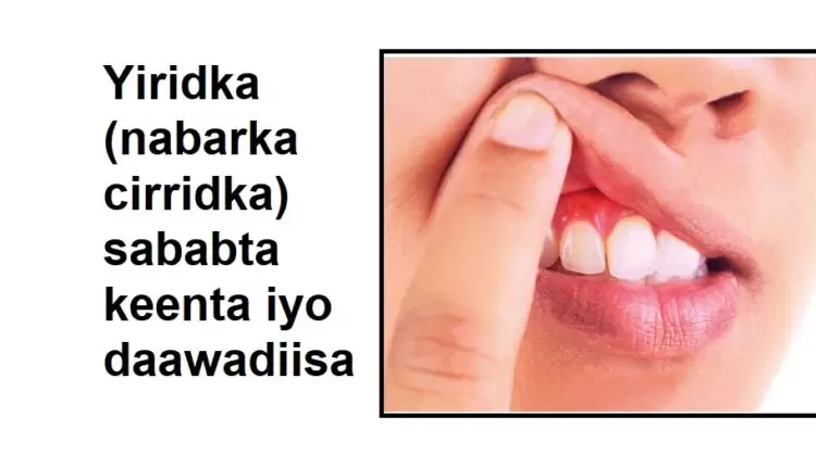 Yiridka (nabarka cirridka) sababta keenta iyo daawadiisa 1