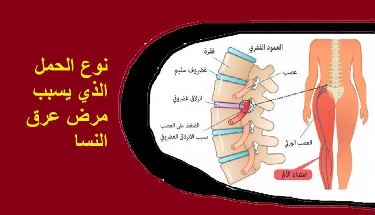 نوع الحمل الذي يسبب مرض عرق النسا1